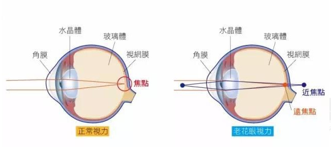 白內障和老花眼區別，老花眼發(fā)病率正呈現年輕化趨勢